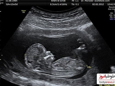 انگشت مکیدن خنده دار و بامزه جنین در شکم مامانش هنگام سونوگرافی+ویدئو